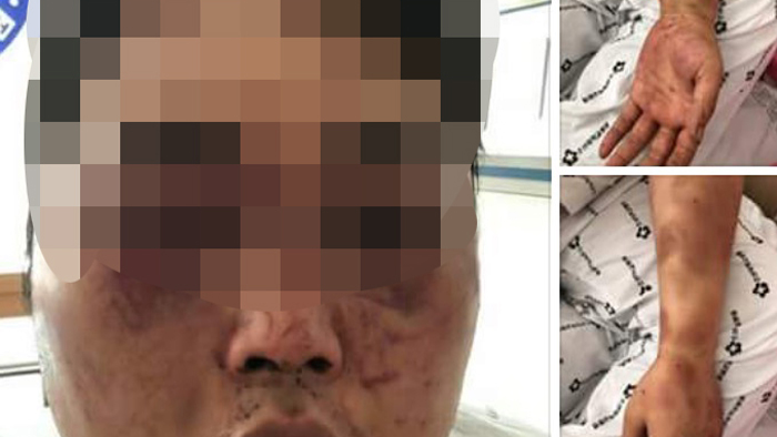 "광주 집단폭행 피해자 왼쪽 눈 사실상 실명 진단"