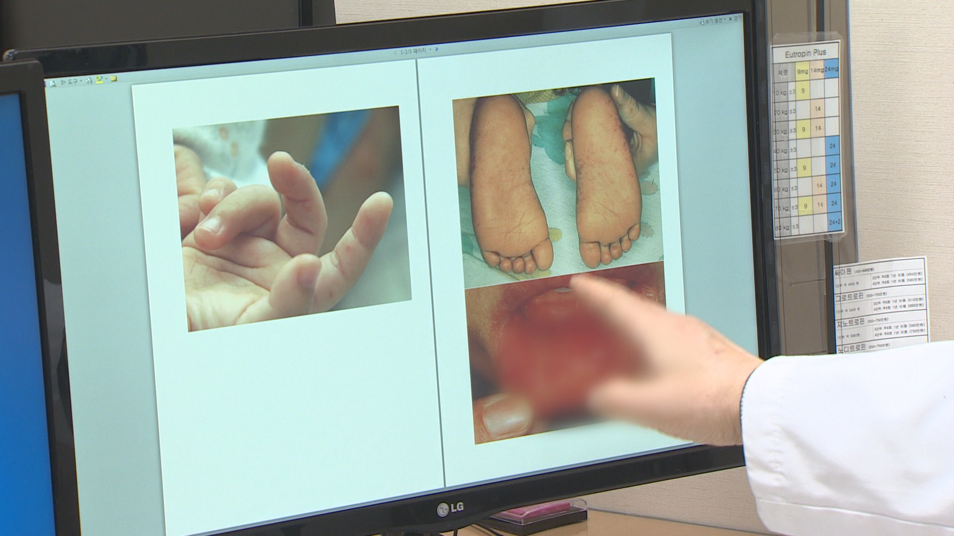 수족구병·눈병 고개…여름철 '영유아 감염병' 주의보